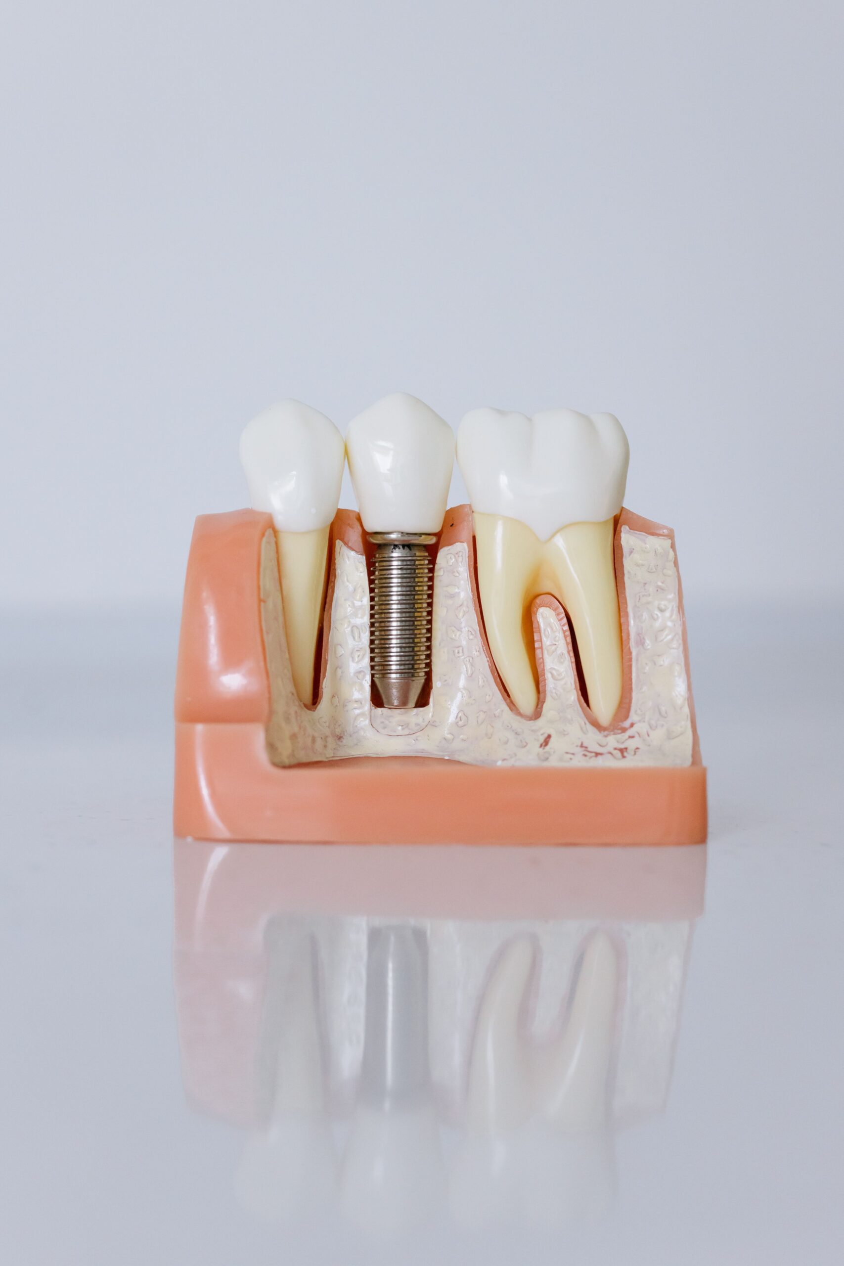 Impianti Dentali